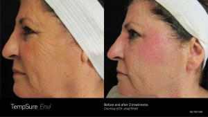 before and after of a womans side face