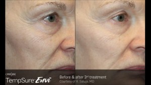 before and after of a woman's side face