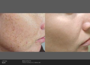 before and after of a girls side face