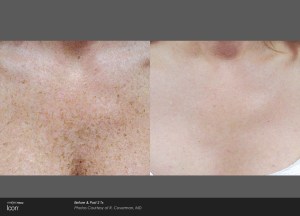 before and after of woman's decolletage